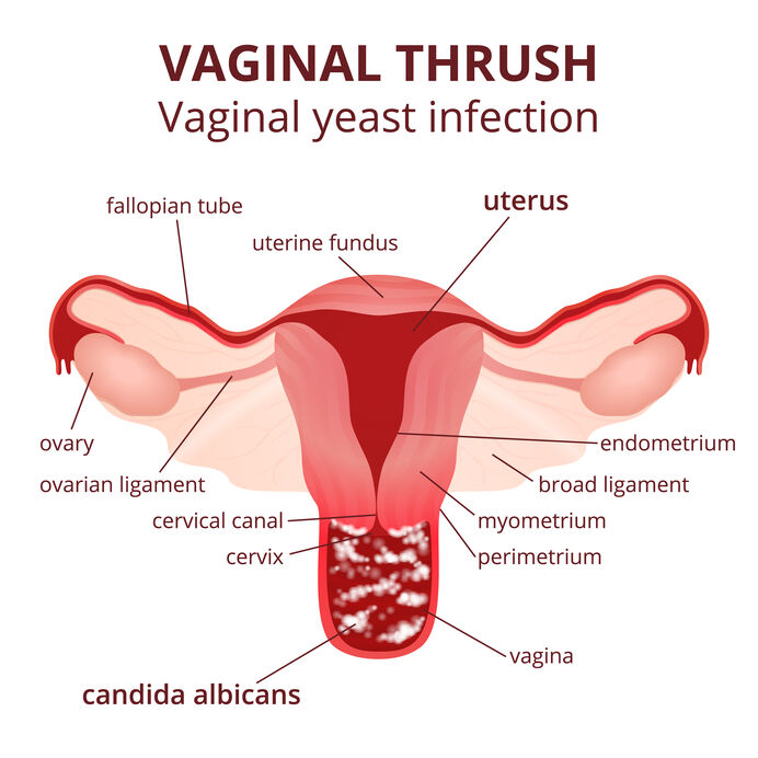 Female reproductive system, the uterus and ovaries scheme vulvovaginal candidiasis or vaginal yeast infection