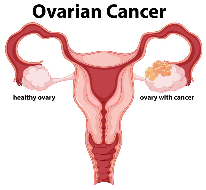 Woman Ovarian Cancer concept drawing illustration